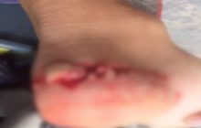 ผู้ว่าฯภูเก็ต ยืนยัน ปลาที่กัดนักท่องเที่ยวไม่ใช่ฉลาม