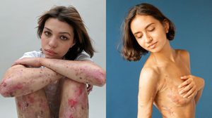 ฉันรักในสิ่งที่ฉันเป็น! เบื้องหลังรอยแผลเป็น กับการสร้างคุณค่าในตัวเองที่ยิ่งใหญ่