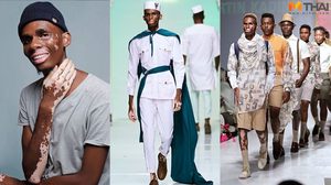 พลิกความต่างเป็นโอกาส มิกี ดีโอ นายแบบด่างขาว ยืนหนึ่งวงการแฟชั่น