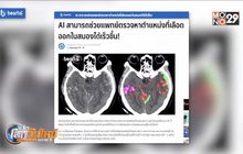 AI ช่วยแพทย์หาตำแหน่งที่เลือดออกในสมอง