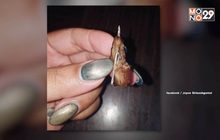 สาวโพสต์เตือนภัยเจอ “เข็มในเนื้อหมู” หวิดกลืนลงท้อง