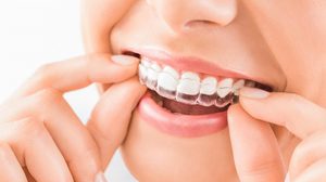 4 วิธีการจัดฟันแบบต่างๆ - จัดฟันแบบเหล็ก เซรามิก 3M และแบบใส