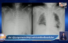 ญี่ปุ่น ประสบความสำเร็จ ปลูกถ่ายปอดให้ผู้ป่วยโควิด