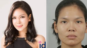 พลิกโฉม!! ศัลยกรรมสาวหน้าเหลี่ยมให้เป็นสาวสวย จากหน้ามือเป็นหลังมือ
