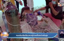 แพทย์อินเดีย เตือน พบผู้ป่วยเชื้อราดำเพิ่มสูงขึ้น