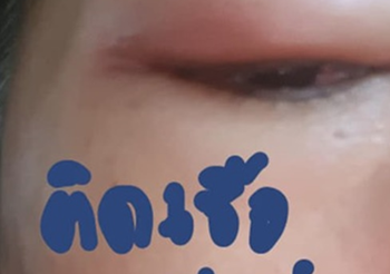 อุทาหรณ์สาวหวิดตาบอด เพราะเห็บเกาะบริเวณดวงตา !