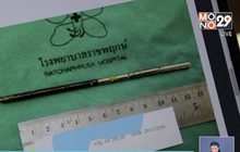 เด็ก 6 ขวบกลืนแม่เหล็กยาว 15 ซม.ลงท้อง