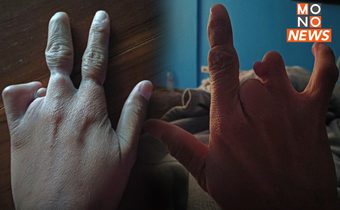 เพจดังโพสต์ภาพ มือพิการระดับไหน จึงได้สิทธิ?