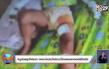 เด็ก 3 ขวบถูกไฟลวก เพราะมีเปลวไฟระหว่างล้างมือด้วยเจลแอลกอฮอล์