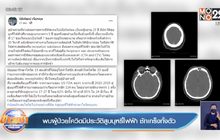 พบผู้ป่วยโควิดมีประวัติสูบบุหรี่ไฟฟ้า ชักเกร็งทั้งตัว