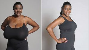 สาวเท็กซัส ได้ชีวิตใหม่ เมื่อ ผ่าตัดหน้าอก ให้เล็กลง