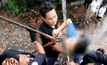 เด็ก 11 ขวบ ปีนรั้วบ้านพลาดถูกเหล็กเสียบคอทะลุปาก
