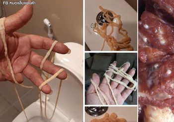 เห็นแล้วสยอง! ภาพพยาธิตัวตืดยาวเฟื้อย ออกจากร่างกายคน