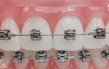 เตือนภัยจัดฟันเถื่อนเสี่ยงติดเชื้อ HIV