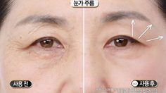 ลืมงานโบท็อกซ์ไปได้เลย Lifting Stick ปาดหน้า 3 ที รู้เรื่อง ตึงทันตา อุ๊ต๊ะ!!!