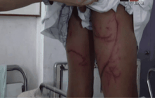 เด็กถูกพิษแมงกะพรุนบริเวณทะเลแหวก จ.กระบี่