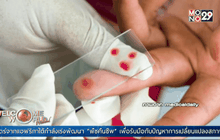 ตรวจหามะเร็งด้วยเลือดเพียงหยดเดียว