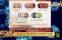 รพ.จุฬา แนะ สังเกตผื่นโควิด อาการบ่งชี้ใหม่ ติดเชื้อ