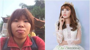 สาวเวียดนาม ทุ่ม 7 แสน ยกเครื่องทำ ศัลยกรรม เปลี่ยนลูกเป็ดขี้เหร่เป็นนางฟ้า แถมได้สามี!