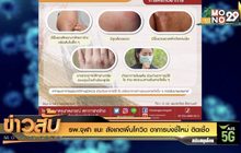รพ.จุฬา แนะ สังเกตผื่นโควิด อาการบ่งชี้ใหม่ ติดเชื้อ