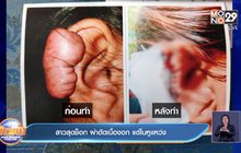 สาวสุดช็อก ผ่าตัดเนื้องอก แต่ใบหูแหว่ง