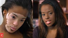 ทารองพื้น ปิดบังผิวจริงมานาน 7 ปี เรื่องราวสุดเจ็บปวด ของหญิงสาวที่ป่วย โรคด่างขาว