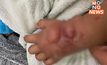 แม่โวย! รพ.เจาะน้ำเกลือ ทำลูก 3 ขวบ มือบวม-พอง