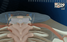 แพทย์อิตาลีผ่าตัดเปลี่ยนหัวลิงสำเร็จในจีน