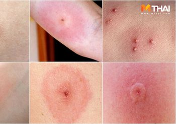 ตัวอะไรกัด? 12 รอยแมลงกัด ตุ่มแดงๆ ขึ้นบนร่างกายแบบนี้ มาจากสัตว์อะไร