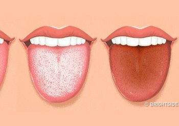 13 สัญญาณ ลิ้นบอกโรคได้ มาดูกันว่าลิ้นของคุณเปลี่ยนเป็นสีอะไร?
