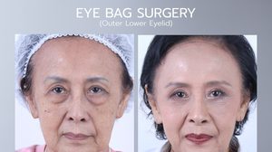 “แม่หน่อย “ ณัฐนี สิทธิสมาน นักแสดงรุ่นใหญ่ โชว์ภาพล่าสุดหลังทำศัลยกรรมตัดถุงใต้ตา แจง..ตั้งใจมา“รักษา”แก้ปัญหาการมองเห็น..แต่ได้ “ความสวย”ด้วยซะเน้…