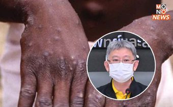 ผู้ป่วยยืนยันโรคฝีดาษวานร รายที่ 8 เป็นชาวไทย เดินทางกลับมาจากประเทศกาตาร์