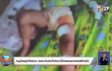 เด็ก 3 ขวบถูกไฟลวก เพราะมีเปลวไฟระหว่างล้างมือด้วยเจลแอลกอฮอล์