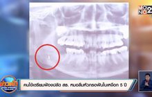 คนไข้เตรียมฟ้องปลัด สธ. หมอลืมหัวกรอฟันในเหงือก 5ปี