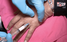 ศัลยกรรมต่อต้านริ้วรอยบนฝ่ามือ