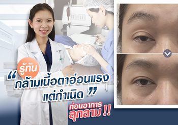 รู้ทัน “กล้ามเนื้อตาอ่อนแรงแต่กำเนิด” รักษาได้ก่อนอาการลุกลาม!