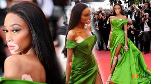 สวยแย่งแฟลช! วินนี่ นางแบบโรคด่างขาว โดดเด่นบนพรมแดงเมืองคานส์ 2018