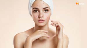 5 วิธีดูแลผิวเป็นสิว จากแสงแดดในฤดูร้อน ตัวการหลักที่ทำให้ผิวคุณพัง!