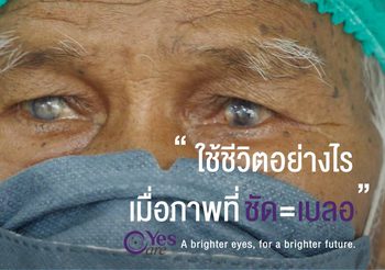 YesCare ร่วมมอบดวงตาใหม่แก่ผู้ยากไร้ใน “โครงการผ่าตัดต้อกระจกใส่เลนส์แก้วตาเทียม”