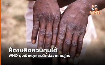 WHO ยืนยันฝีดาษลิงควบคุมได้ แพร่ระบาดได้ยาก พุ่งเป้าหยุดการติดต่อจากคนสู่คน