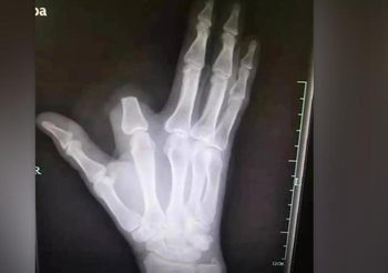 ชายชาวจีนตัดนิ้วทิ้งหลังงูกัด ด้านแพทย์แนะไม่จำเป็น แค่รู้จักวิธีปฐมพยาบาลก็พอ