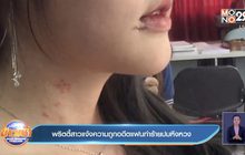 พริตตี้สาวแจ้งความถูกอดีตแฟนทำร้ายปมหึงหวง