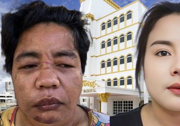 โรงพยาบาลเอเซียโชว์ผลงาน ระดมทีมแพทย์แก้ไขใบหน้า “น้องเอ” สวยออร่าราวกับเกิดใหม่ หลังถูกทารุณเสียโฉม