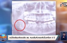 คนไข้เตรียมฟ้องปลัด สธ. หมอลืมหัวกรอฟันในเหงือก 5ปี