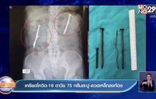 เครียดโควิด-19 ตาวัย75 กลืนตะปู-ลวดเหล็กลงท้อง