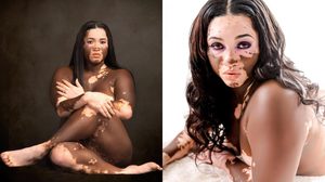 สาวป่วยเป็น โรคด่างขาว จากคิดฆ่าตัวตาย กลับมาภูมิใจในสิ่งที่เป็น!