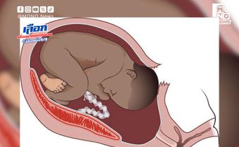 รู้จักภาวะมดลูกแตก ภัยเงียบคร่าชีวิตแม่–ทารก