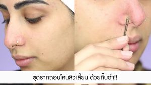 ขุดรากถอนโคนสิวเสี้ยน ด้วยกิ๊บดำ!! ของใกล้ตัวที่สาวๆ นึกไม่ถึง