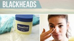 How to วิธีกำจัดสิวหัวดำ ทำง่ายๆ แค่ใช้ วาสลีน!