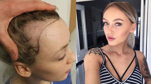 เตือน! สาวที่ชอบรวบผมตึงทุกวัน วันหนึ่งคุณอาจต้อง ปลูกผม เหมือนเธอคนนี้